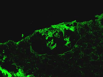 ANCA-Associated Vasculitis With Anti-GBM Disease and Two Types of Tumors: A Case Report